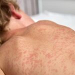 Alberta Reports 58 Measles Cases as Health Officials Urge Immunization