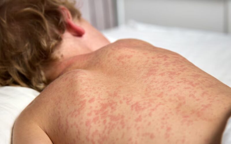 Alberta Reports 58 Measles Cases as Health Officials Urge Immunization
