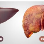 Fatty Liver Disease can be reversed with right diet and lifestyle