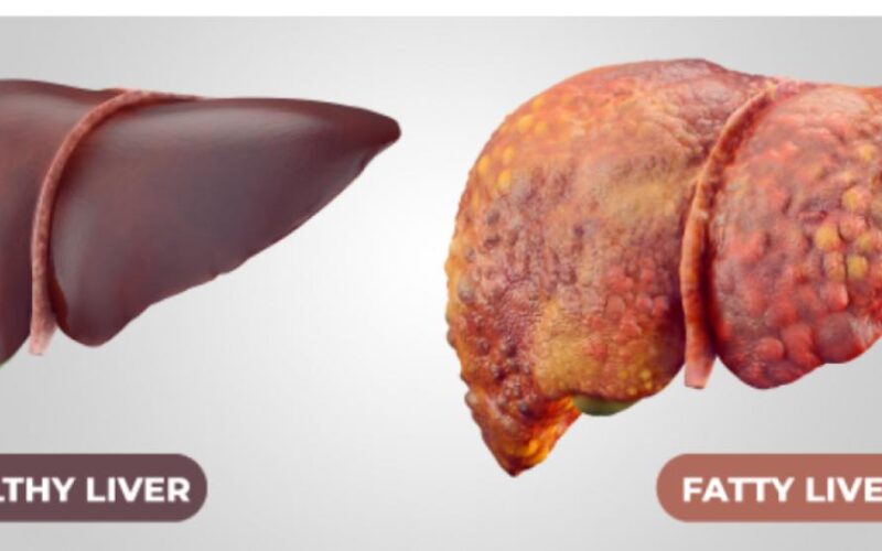 Fatty Liver Disease can be reversed with right diet and lifestyle