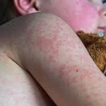 Measles Cases in Alberta Surge Over the Weekend, Topping U.S. Total