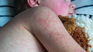 Measles Cases in Alberta Surge Over the Weekend, Topping U.S. Total