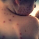 Bangladesh Measles Crisis Deepens as Death Toll Reaches 585
